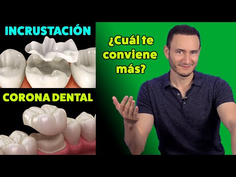 Incrustación vs Corona Dental ¿Cuál te conviene más? | (Cuando está indicada)