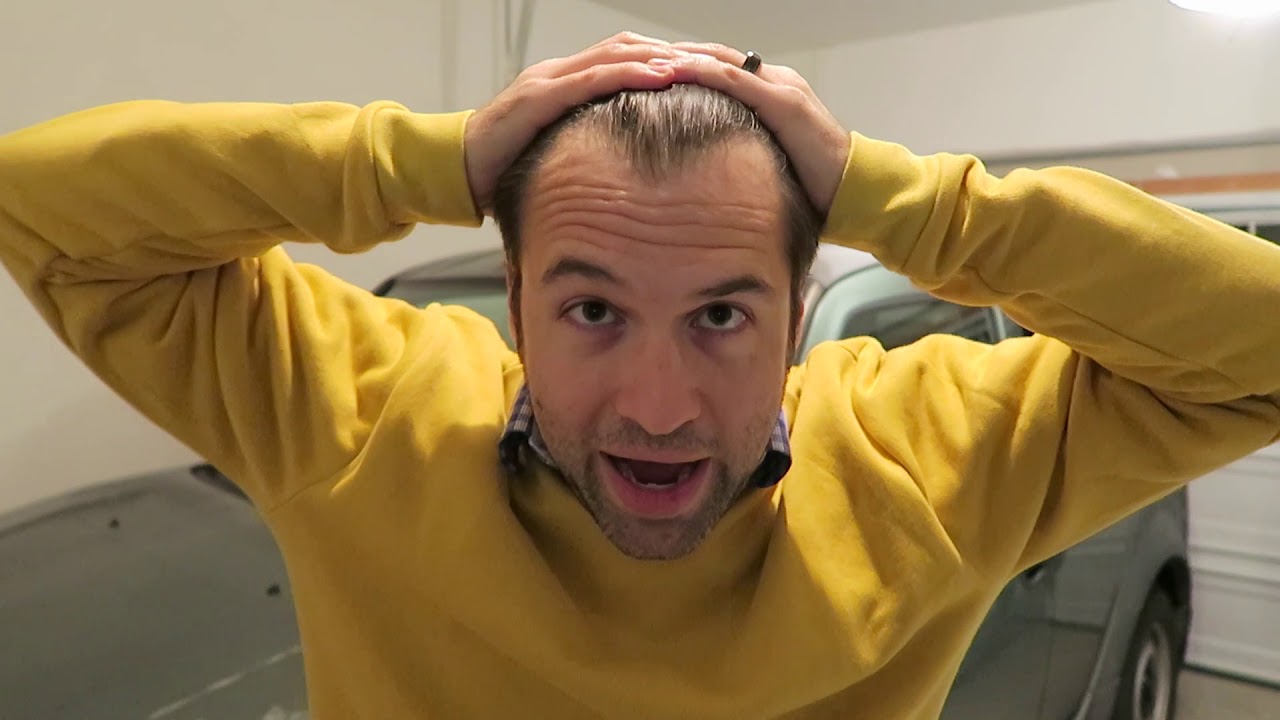 Norwood 3 Hair Loss Everything You Need To Know  Get In Touch