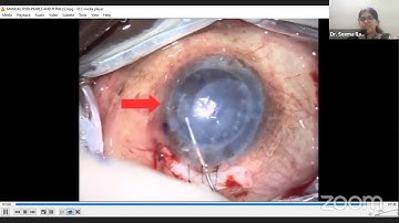 Pearls and Pitfalls of DSEK & Endothelial Keratoplasty Triple - EYE TODAY TALK - Dr Seema