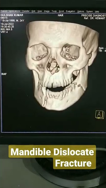Facial bone fracture