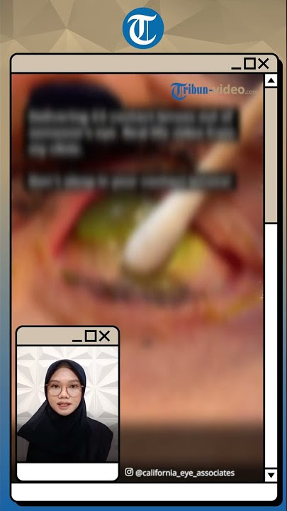 Bikin Tercengang, Sebanyak 23 Softlens Bersarang di Mata Seorang Wanita