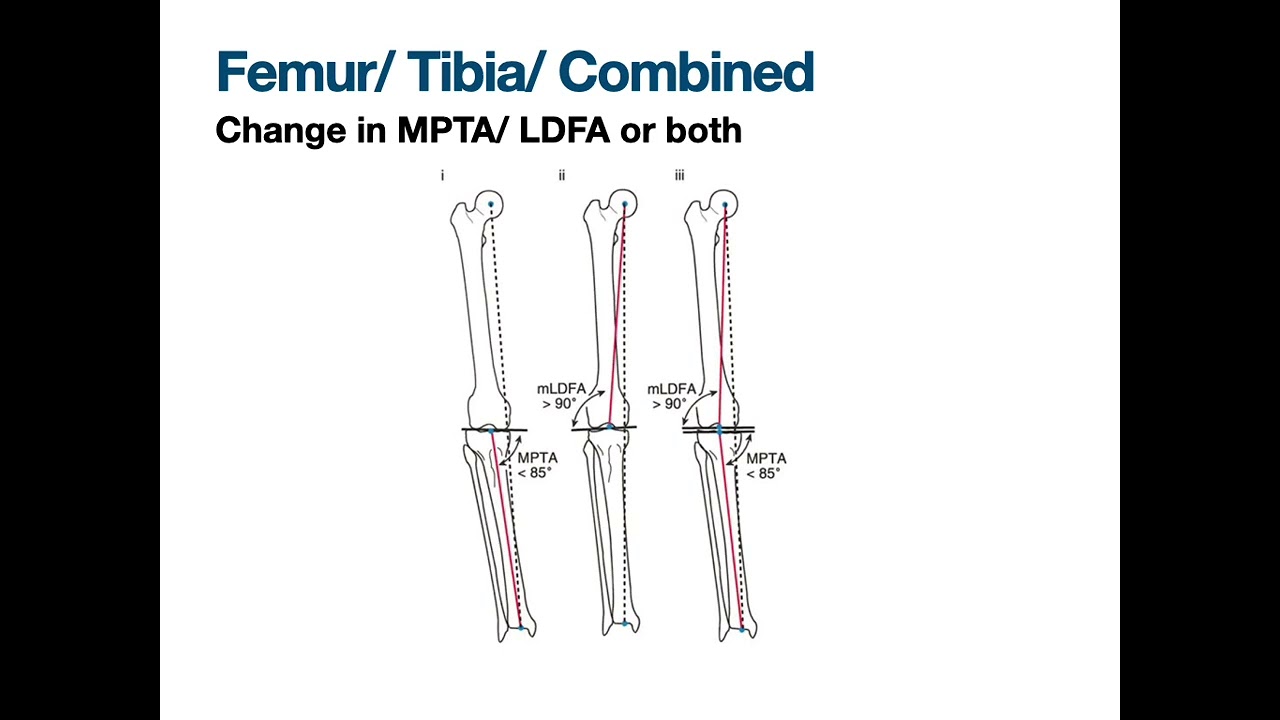 How to choose between High Tibial Osteotomy, UKR and TKR? - A guide to making an Informed choice!