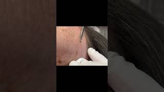Dont Try This at Home: Milia Extraction
