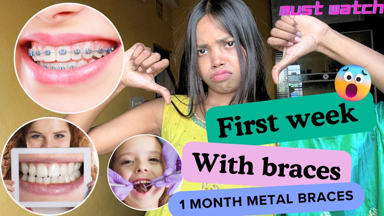 First week with METAL BRACES😱| what i eat with braces| pain and my experience🥴#dental #metalbraces