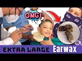 How to remove hard wax from small children           otoscaopy