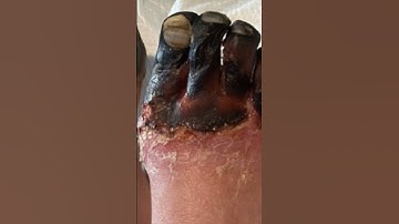 What is Frostbite?