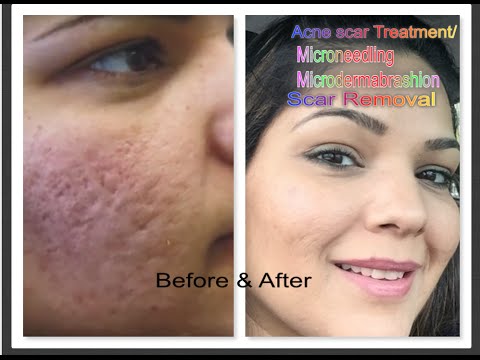 Part  Acne scar treatment| Micro needling| Microdermabrasion| Pimples, Skin Problems