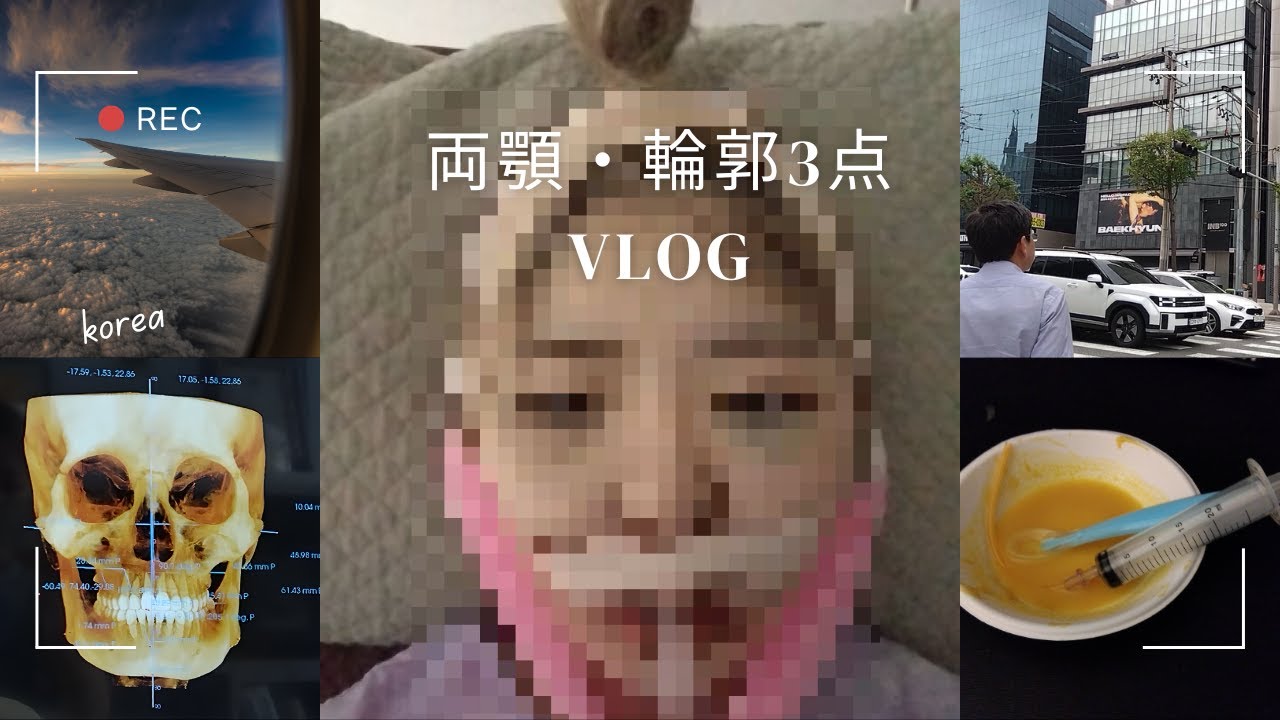 【韓国整形完全ガイド】　両顎・輪郭3点手術ってこんな感じです