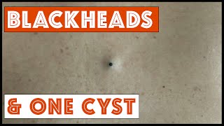 Blackheads and One Cyst