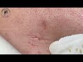 Satisfying Deep Hidden Pimple Pops | ASMR Skincare Therapy | Pimple Heaven #10