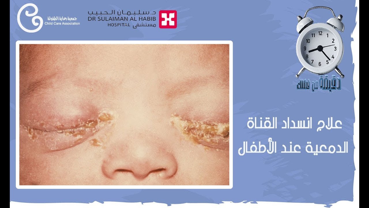 علاج انسداد القناة الدمعية عند الأطفال (دقيقة من فضلك) جمعية رعاية الطفولة