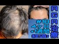 AGA治療4ヶ月+1週間経過！初期の焦りはなく長期継続の安心感が少し出ました！