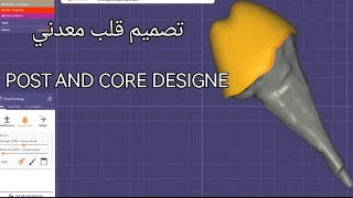 تصميم قلب معدني بواسطة اكسوكاد post and core design by exocad