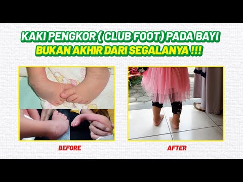 BUKAN AHIR DARI SEGALANYA | CTEV, Club Foot, Kaki Pengkor Pada Bayi