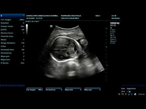 Video: Cómo leer una imagen de ultrasonido: 9 pasos (con imágenes)