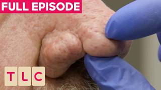 FULL EPISODE | Dr Emma Removes 20-Year-Old Deep, Painful Nose Cysts | The Bad Skin Clinic