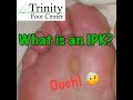What is an Intactable Plantar Keratosis or IPK?
