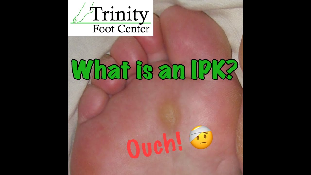 25 Intractable Plantar Keratosis AlytaAlicica 1-5-intractable-problems-ppt-download