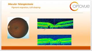 OCT Interpretation Session 10 Macular Telangiectasia