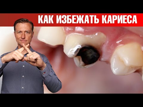 Как избежать кариеса и не допустить его появления?👀