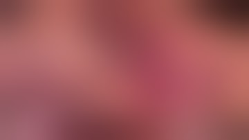 Laparoscopic left lateral sectionectomy and lymphadenectomy for intrahepatic cholangiocarcinoma