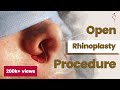 Nose Job Surgery (Open Rhinoplasty Surgery) | Procedure | Rhinoplasty in India
