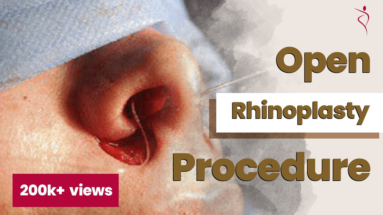 Open Rhinoplasty Complete Surgery Nose Job Surgery Rhinoplasty in