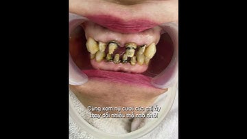 Bộ Răng Sứ Này Đã Được 15 Năm Xứng Đáng Làm Lại Quá Rồi! #rangsu #rangsuthammy #lamrang