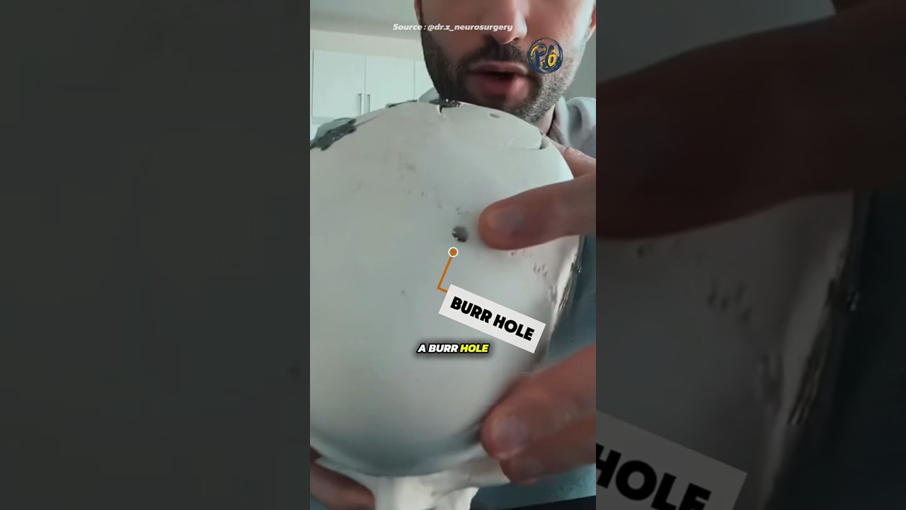 🧠 Как врачи безопасно сверлят человеческий череп 🤔❓