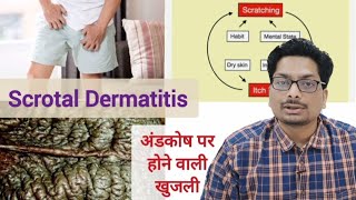 Causes of itching on the testicles - Part 1 Scrotal Dermatitis | Scrotal Eczema #scrotaldermatitis