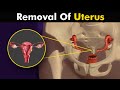 What happens in hysterectomy uterus removal surgery animation