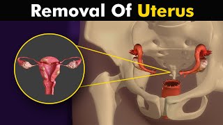 What happens in hysterectomy? Uterus Removal surgery animation screenshot 2