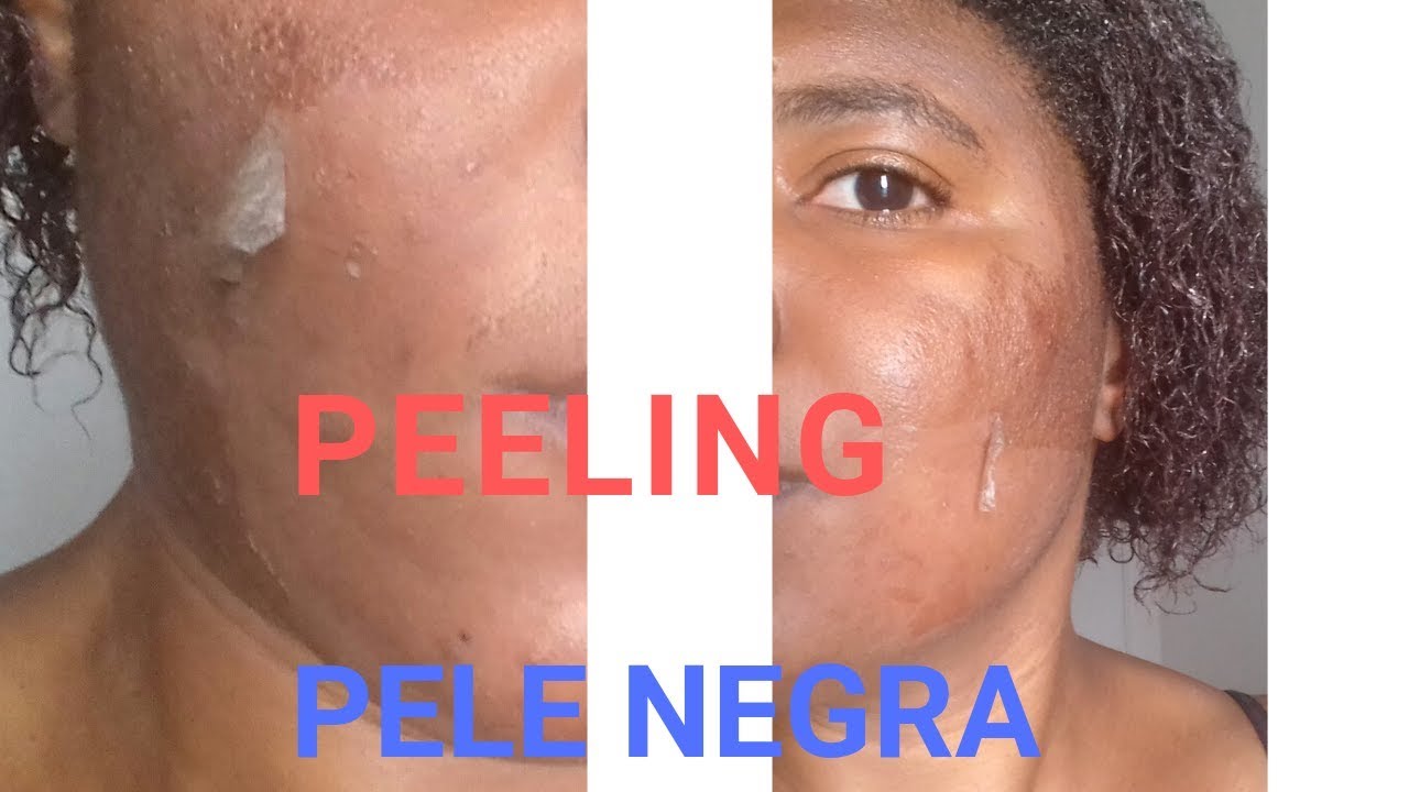 Chemical Peeling On Black Skin My Experienci Photos Youtube
