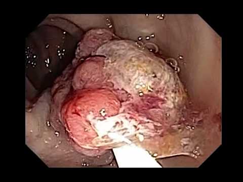Endoscopic management of colorectal polyp
