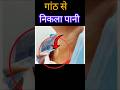 Thyroid Cyst #shorts #youtubeshorts #nursingstudent #nursing #nurse #hospital #injection #thyroid