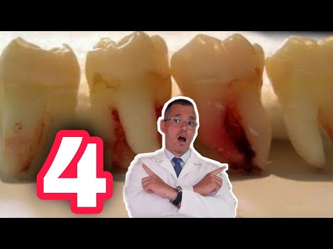 Vídeo: Posso remover todos os dentes do siso de uma vez?