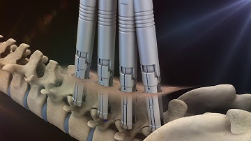 QUATTRO-GADGET MIS Percutaneous Screw System