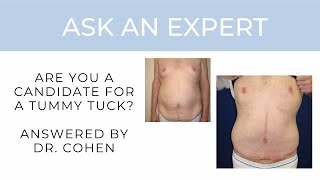 Are You a Candidate for a Tummy Tuck? (Dr. Andrew Cohen Answers)