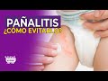 👉 Pañalitis: lo que toda mamá debe saber para prevenirla