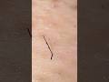 #plucking #satisfying #tweezers #毛抜き #blackheads #埋没毛 #ingrownhair #skincare #pimple #hairremoval