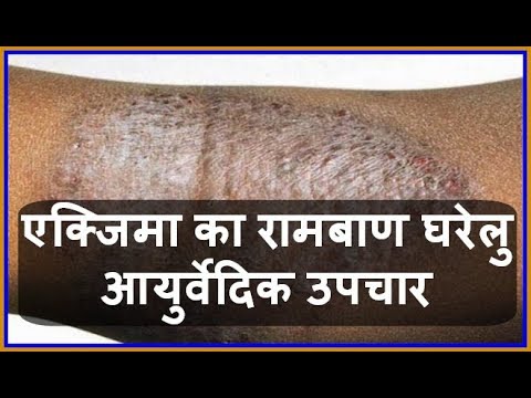 Health Tips- एक्जिमा  का रामबाण घरेलु आयुर्वेदिक उपचार | Charm Rog | Eczema ka Gharelu Upchar |