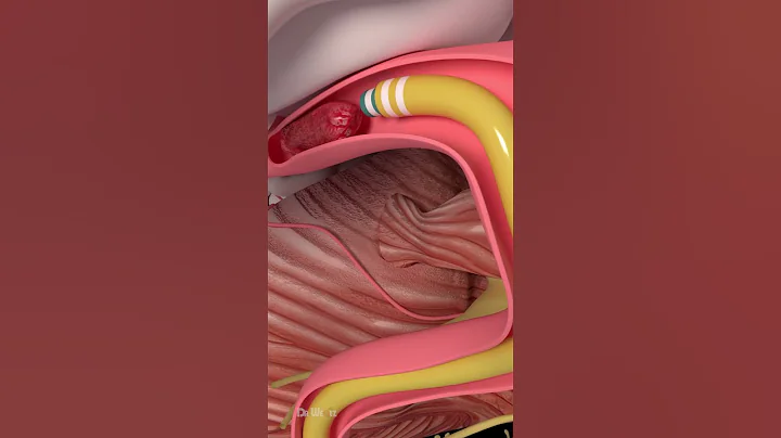 How Are Blood Clots Removed - DayDayNews