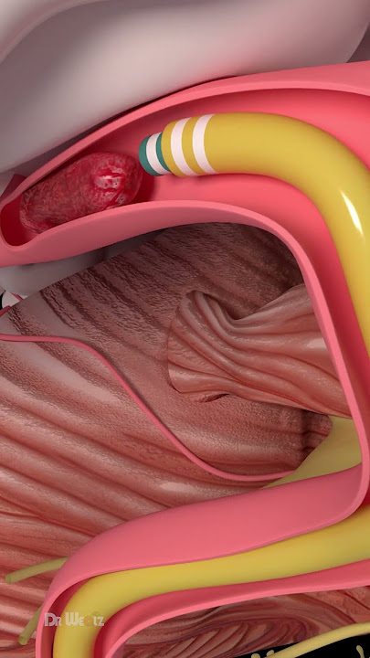 How Are Blood Clots Removed