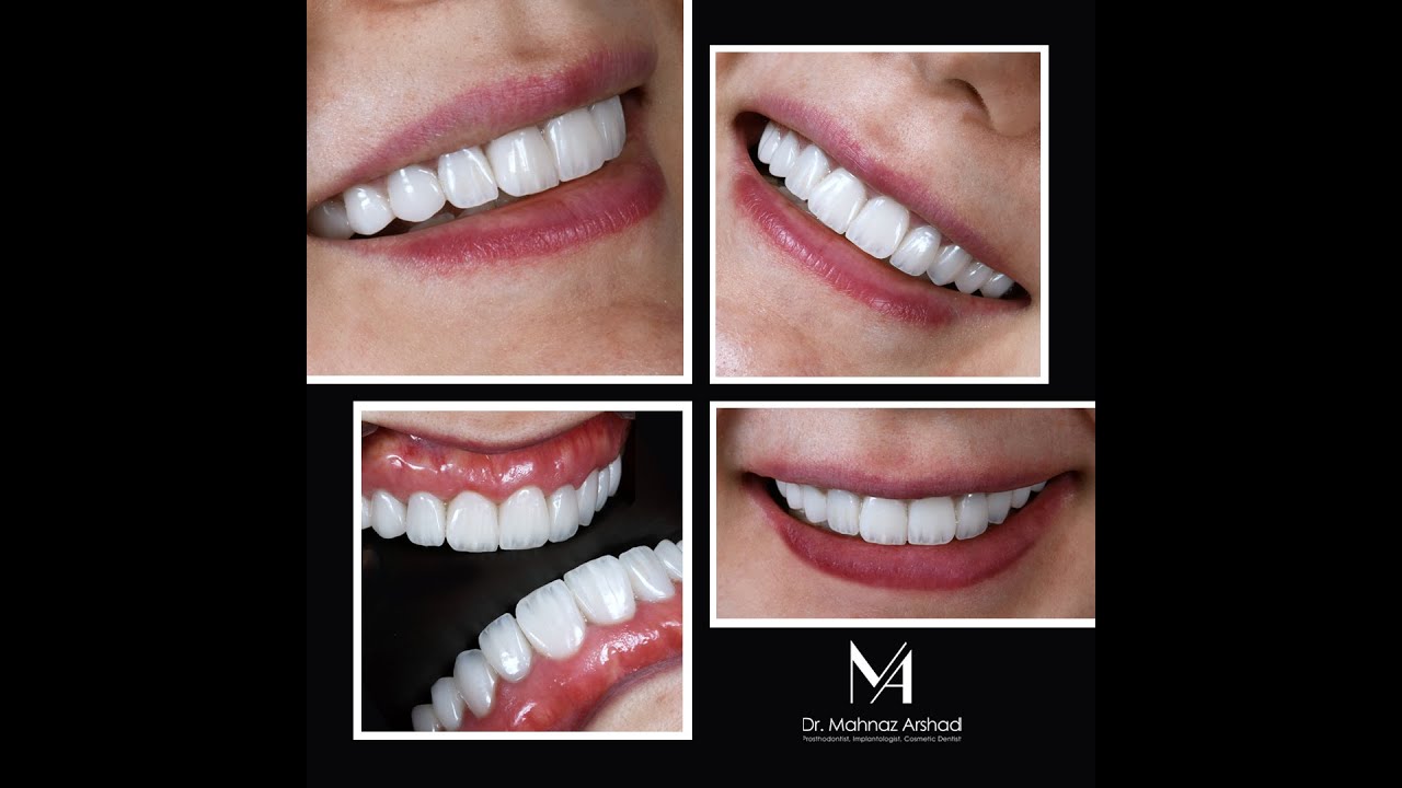 لمینیت های دندانی، طراحی لبخند، تراش، قالبگیری و تحویل