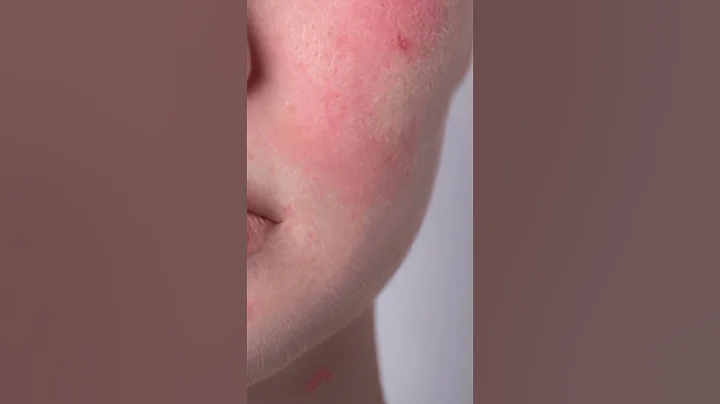 Stop Using Toothpaste on Pimples! Here’s Why It’s a Bad Idea #shorts