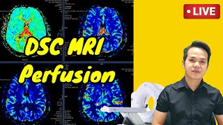 Brain Perfusion MRI