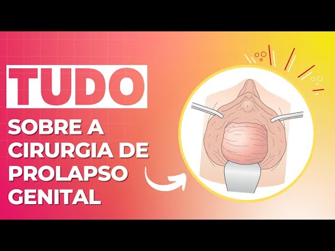 Vídeo: Quanto custa a cirurgia de prolapso?