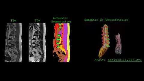 Lumbar Spine Segmentation