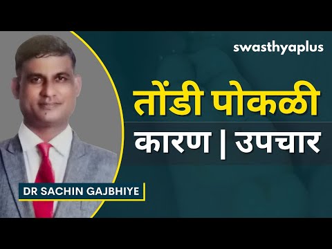 तोंडी पोकळी: लक्षणे उपचार | Oral Cavities/ Tooth Decay in Marathi | Dr Sachin Gajbhiye