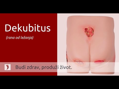 Dekubitus – rana od ležanja